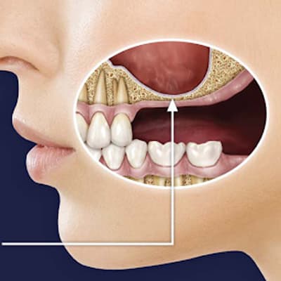 Sinus Lifting Tedavisi