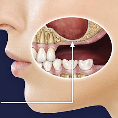 Sinus Lifting Tedavisi